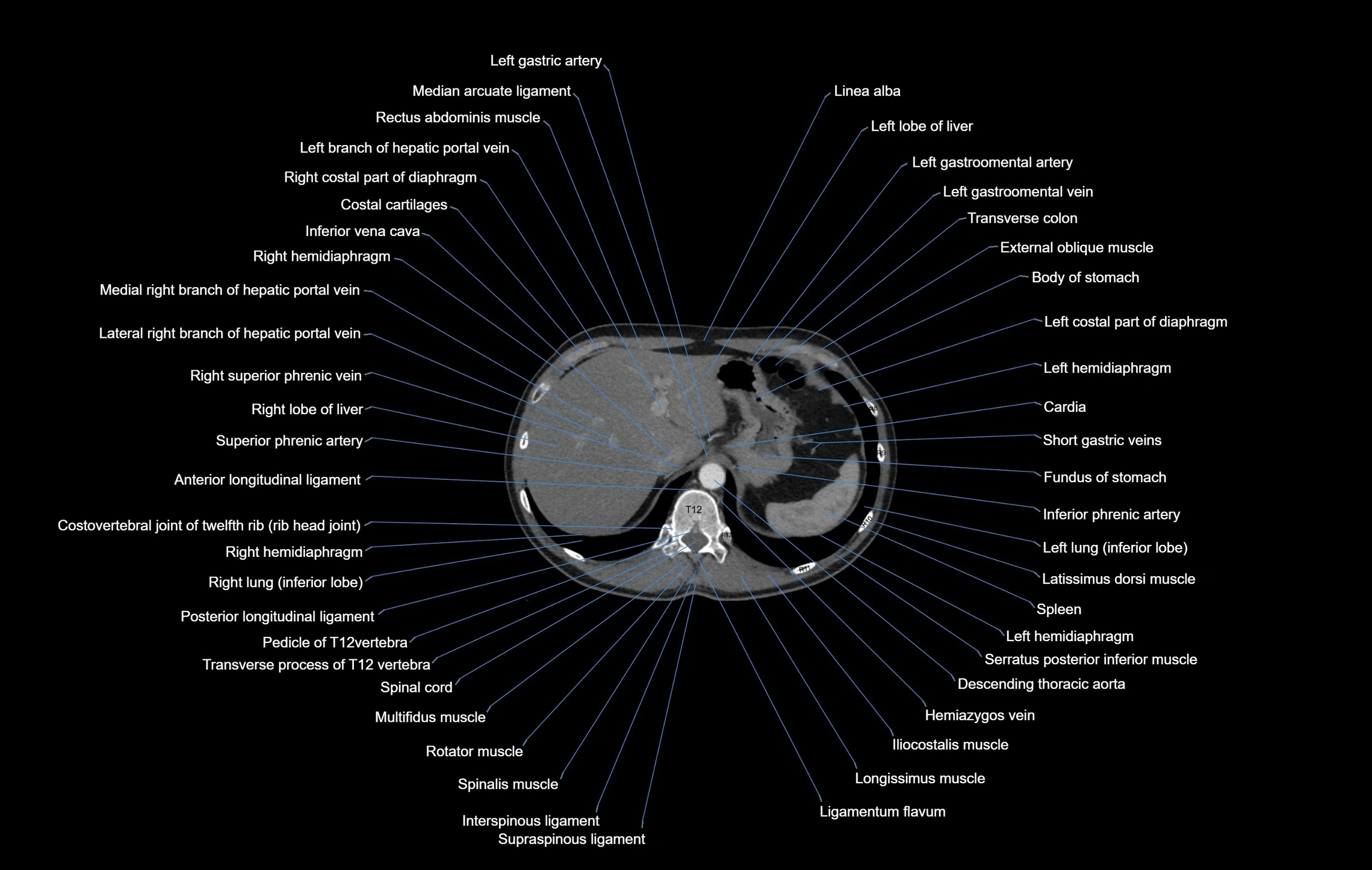 CT chest (thorax) soft tissue window labelled axial cross sectional anatomy radiology image-00112.webp